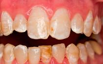 Флюороз зубов — причины, особенности и методики лечения заболевания Флюороз причины