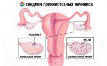 Поликистоз яичников — что это, причины, первые признаки, симптомы, лечение поликистоза и диета От чего появляется поликистоз яичников у женщины